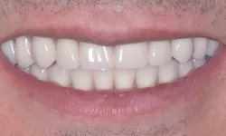 Thumbnail control image for Close-up of a smiling mouth showing straight, white teeth and natural lip texture.