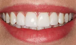 Thumbnail control image for Close-up of a bright smile showing clean, white teeth and red lips with natural texture and shine.