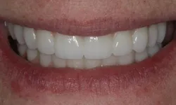 Thumbnail control image for Close-up of a bright, white smile with clean teeth and natural lips in soft lighting.
