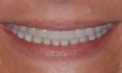 Thumbnail control image for Close-up of a smiling mouth showing clean, white teeth and natural lip texture under soft light