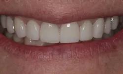 Thumbnail control image for Close-up of a smiling mouth with clean, white, evenly spaced teeth and natural lips.