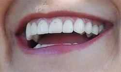 Thumbnail control image for Close-up of smiling mouth showing healthy, white teeth and pink lips with natural skin texture.