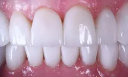 Thumbnail control image for Close-up of healthy white teeth and pink gums with natural shine and smooth texture
