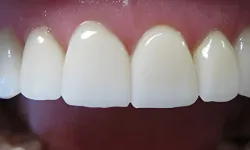 Thumbnail control image for Close-up of clean, white upper front teeth with healthy pink gums in a dental health image.