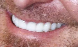 Thumbnail control image for Close-up of a smiling man's mouth showing clean white teeth and facial stubble.