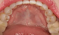 Thumbnail control image for Close-up of an open mouth showing upper teeth and palate with natural tooth color and structure.