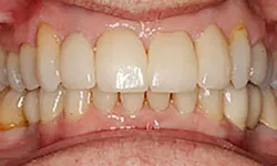 Thumbnail control image for Close-up of imperfect human teeth showing discoloration and plaque along gums and between teeth.