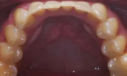 Thumbnail control image for Close-up of upper teeth and gums showing natural tooth alignment and oral cavity details.