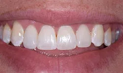 Thumbnail control image for Close-up of a smiling mouth showing clean, well-aligned white teeth and healthy pink lips.