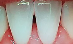 Thumbnail control image for Close-up of healthy upper front teeth and pink gums with natural texture and slight spacing