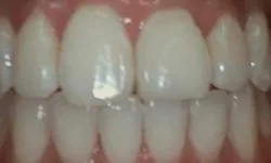 Thumbnail control image for Close-up of healthy, clean human teeth with pink gums and natural shine under light reflection.