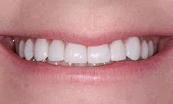 Thumbnail control image for Close-up of a smiling mouth showing clean, white, and evenly aligned teeth.