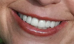 Thumbnail control image for Close-up of a smiling mouth with white teeth and natural glossy lips showing fine skin texture.
