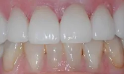 Thumbnail control image for Close-up of upper and lower teeth showing dental alignment and gum health with slight discoloration on lower teeth.