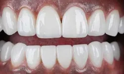 Thumbnail control image for Close-up of bright white human teeth and gums with perfect dental alignment and healthy appearance