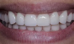 Thumbnail control image for Close-up of a bright, healthy smile showing clean, white teeth and natural lips.