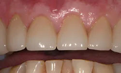Thumbnail control image for Close-up of upper and lower teeth showing dental crowns and gum tissue in a healthy mouth.
