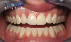 Thumbnail control image for a person's mouth with teeth showing
