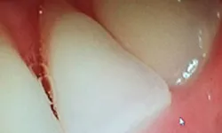 Thumbnail control image for Close-up of healthy white teeth and pink gums with natural texture and shine visible.