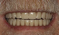 Thumbnail control image for Close-up of an elderly person's mouth showing aged, yellowed teeth and a mustache.