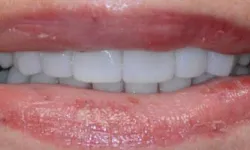 Thumbnail control image for Close-up of lips with chapped skin and white teeth visible in a slight smile.