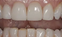 Thumbnail control image for Close-up of human teeth showing upper front dental crowns and lower natural teeth with some wear.