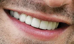 Thumbnail control image for Close-up of a smiling man's mouth showing white teeth and light facial hair stubble on skin.
