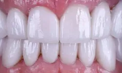 Thumbnail control image for Close-up of clean, white teeth with healthy pink gums and natural shine in a smiling mouth.