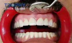 Thumbnail control image for a person's mouth with teeth and a spoon in it