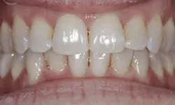 Thumbnail control image for Close-up of healthy human teeth with visible gums and slightly open mouth showing upper and lower teeth.
