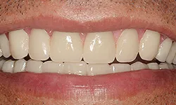 Thumbnail control image for Close-up of a smiling mouth showing clean, white upper and lower teeth with natural lips and skin texture.