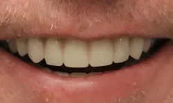 Thumbnail control image for Close-up of a smiling mouth showing natural, clean teeth and slightly dry lips with facial hair nearby