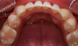 Thumbnail control image for Close-up of upper teeth and gums inside a mouth showing dental anatomy and oral hygiene.