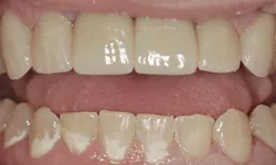 Thumbnail control image for Close-up of upper and lower teeth showing dental discoloration and white spots on several teeth.