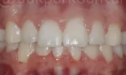 Thumbnail control image for Close-up of upper and lower teeth showing mild crowding and gingival redness in a dental examination.