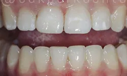 Thumbnail control image for Close-up of upper and lower natural teeth showing slight gaps and healthy gums