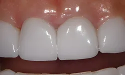 Thumbnail control image for Close-up of upper front teeth with dental veneers reflecting light from surrounding area clean and white