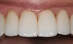 Thumbnail control image for Close-up of clean, white upper front teeth showing healthy gums and smooth enamel surface