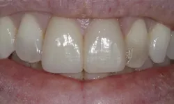 Thumbnail control image for Close-up of a smile showing clean, white upper front teeth and lips with natural texture.