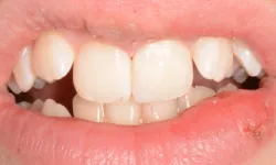 Thumbnail control image for Close-up of a mouth with missing front teeth and a small sore on the lower lip.