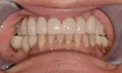Thumbnail control image for Close-up of upper dental crowns and lower natural teeth with gum recession and discoloration