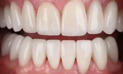 Thumbnail control image for Close-up of a healthy smile showing clean, white, well-aligned teeth and pink gums