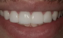 Thumbnail control image for Close-up of a smile showing white upper front teeth and natural lips.