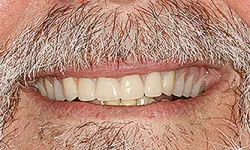 Thumbnail control image for Close-up of a smiling mouth with natural teeth and gray facial hair on upper lip and chin.