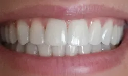 Thumbnail control image for Close-up of a bright, healthy smile showing perfectly aligned white teeth and natural pink gums.