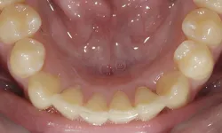 Thumbnail control image for Close-up view of lower teeth and gums showing mild crowding and healthy oral tissue.