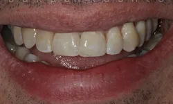 Thumbnail control image for Close-up of a smiling mouth showing upper teeth with slight discoloration and natural texture on lips.