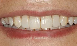 Thumbnail control image for Close-up of a person's smile showing slightly yellowed teeth with a natural lip and skin tone.