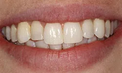 Thumbnail control image for Close-up of a smiling mouth showing natural white teeth and healthy lips.