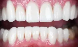 Thumbnail control image for Close-up of healthy, clean upper and lower teeth with pink gums and bright white enamel.